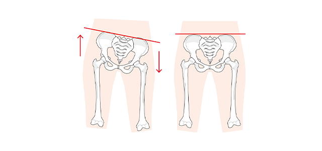 骨盤の歪みイメージ